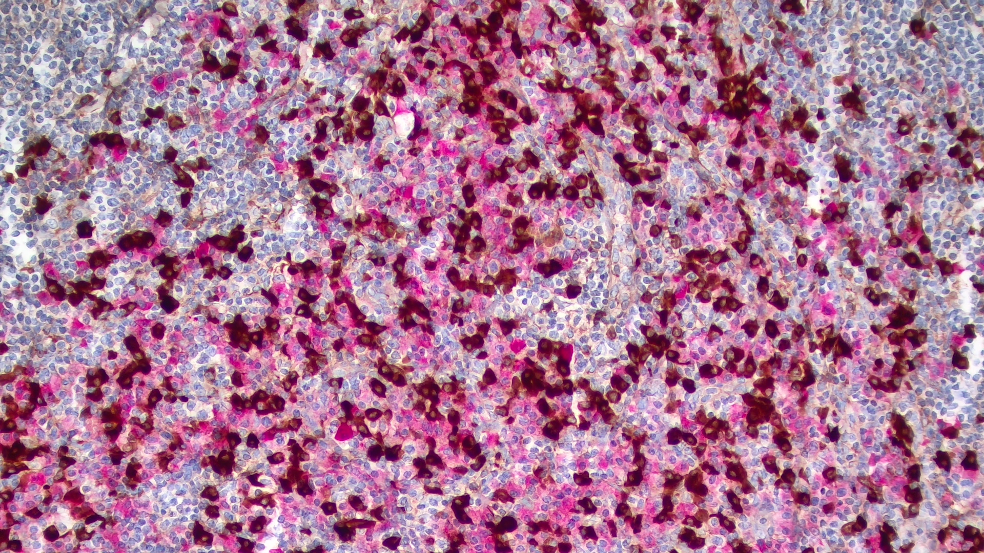 B CELL CLONALITY COCKTAIL